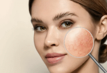 Top Treatments for Redness-Prone or Sensitive Skin